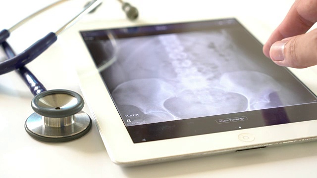 医生在平板电脑上检查x射线图像视频下载