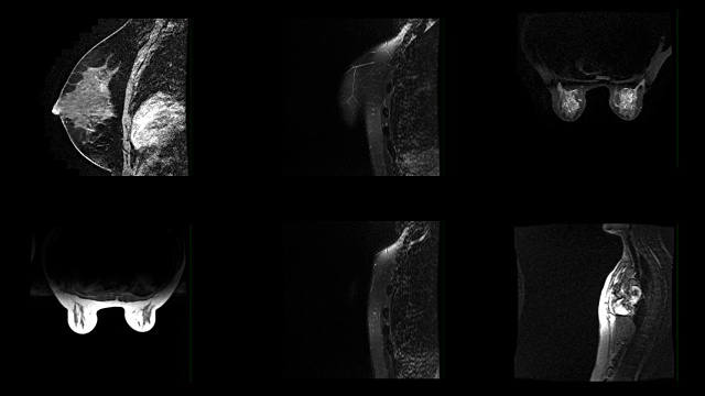 女性乳房MRI扫描视频下载