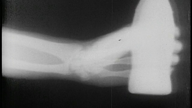 1953年B/W近距离x光照片的手骨+手腕弯曲，使拳头+伸手去拿瓶子视频下载