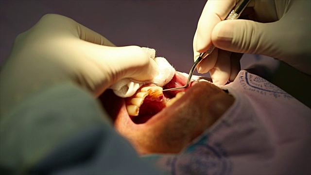 牙科植入物。视频下载
