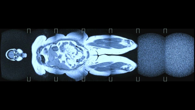 一个肥胖妇女的核磁共振扫描视频下载
