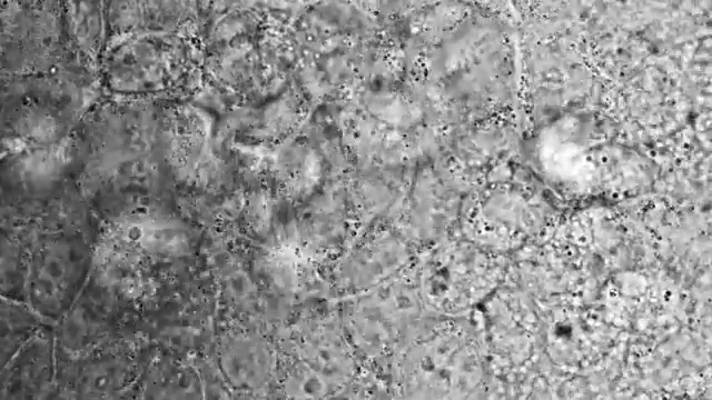 “大肠癌细胞，光学显微镜”视频下载