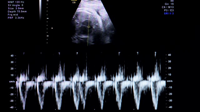 婴儿心跳的超声波图像视频素材