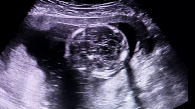 一个婴儿的超声波图像视频素材