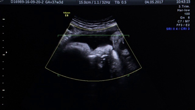 人类胎儿的3D超声波视频素材