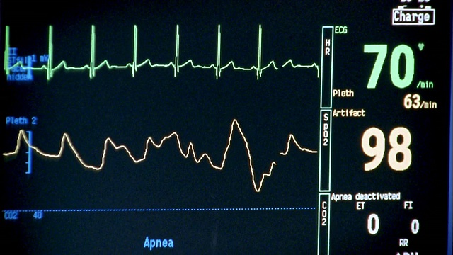 近距离观察医院监护仪显示的心电图波形视频下载