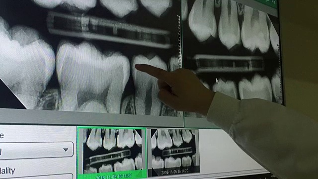 牙科医生的手在监视器上对牙齿进行全景x光扫描视频素材