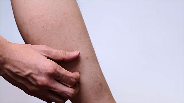 一个男人在他的腿上抓了一个发痒的疹子视频下载