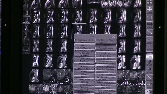 CU PAN TU TD主要研究计算机屏幕上脊柱的x射线和CT扫描图像/美国佛蒙特州南伯灵顿视频下载