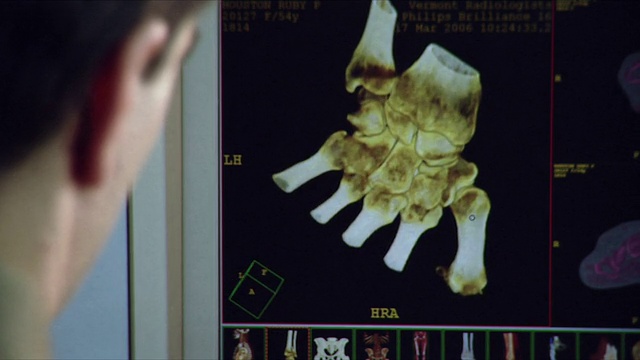 CU医生在电脑屏幕上分析骨骼旋转显示/美国佛蒙特州伯灵顿视频下载