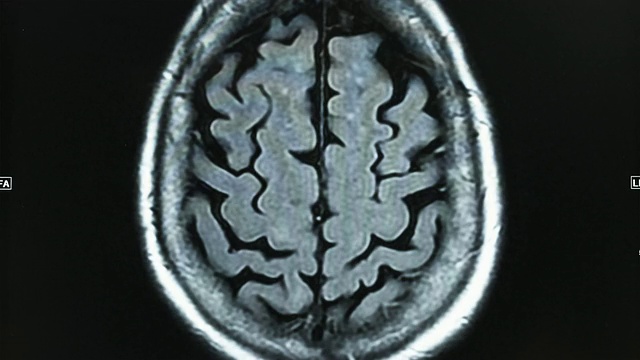 CU 脑部扫描 / 佩森， 犹他州， 美国视频下载