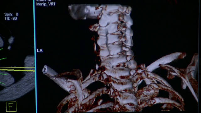 美国佛蒙特州伯灵顿的电脑显示器上旋转3D CAT扫描人体颈部图像视频下载