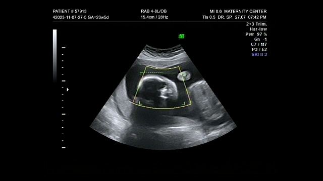 年轻母亲妊娠期人类婴儿胚胎超声3D 4D，第一个婴儿新生儿在妇产医院的ecograph显示屏上检查视频素材