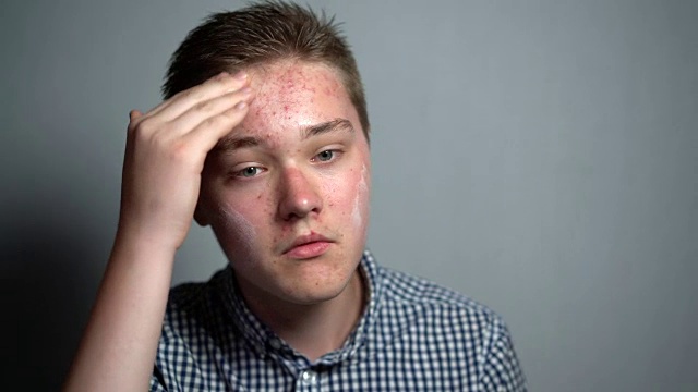 一个男人在他发炎的脸上涂霜。一个不快乐的少年在照顾他的皮肤问题。护肤的概念视频素材
