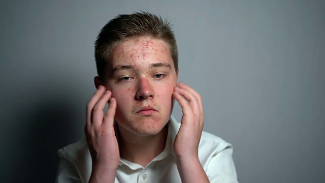 有青春痘问题的小男孩触摸他的脸皮肤视频素材