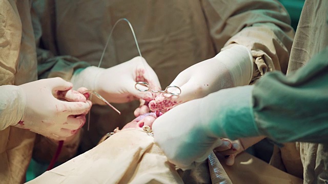 三个外科医生在外科手术室里做手术视频素材