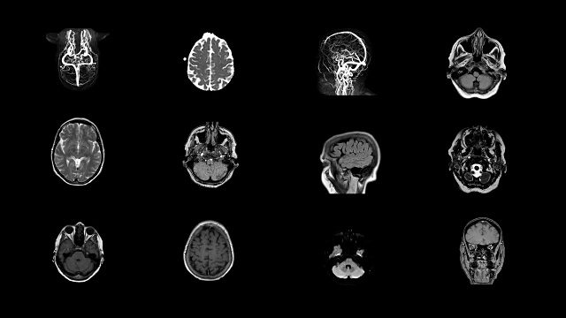 人脑MRI扫描视频素材