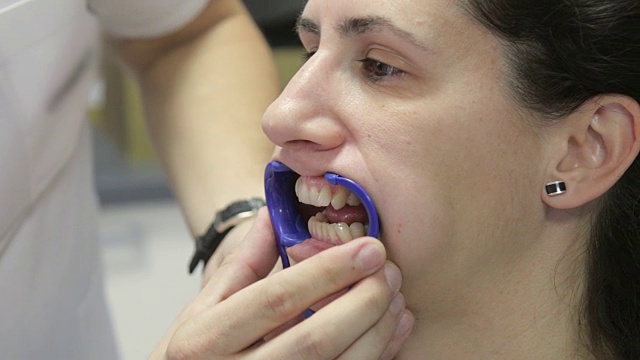 将牙侧牵开器放入患者口中视频素材