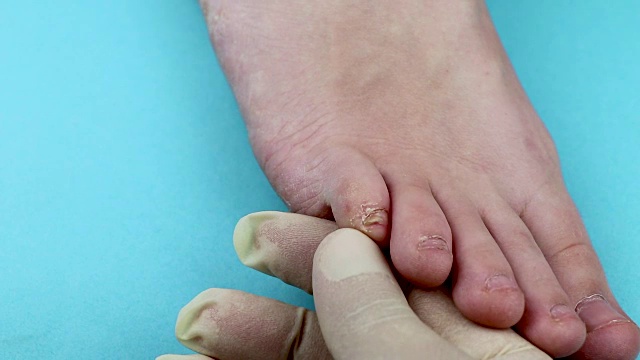 皮肤科医生检查病人 脚部真菌特写 孤立在蓝色背景上 皮肤科 的概念 治疗真菌和真菌感染的人类 宏观拍摄人类寄生虫 视频素材 Id Vcg42n Vcg Com