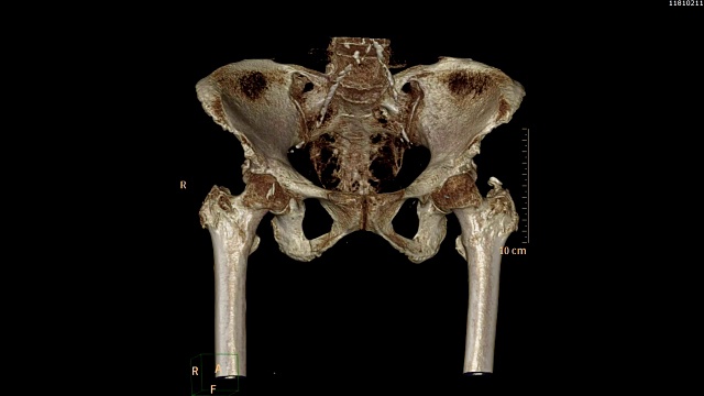 骨盆骨/髋骨CT扫描图像。视频素材