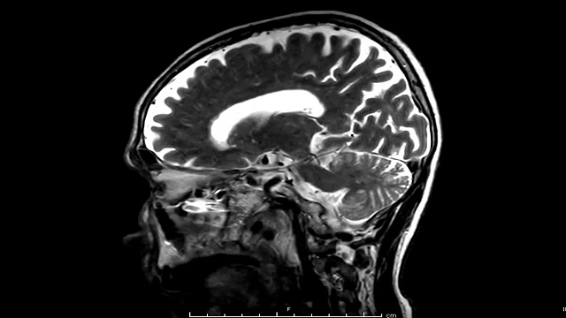 脑矢状面造影剂MRI视频下载