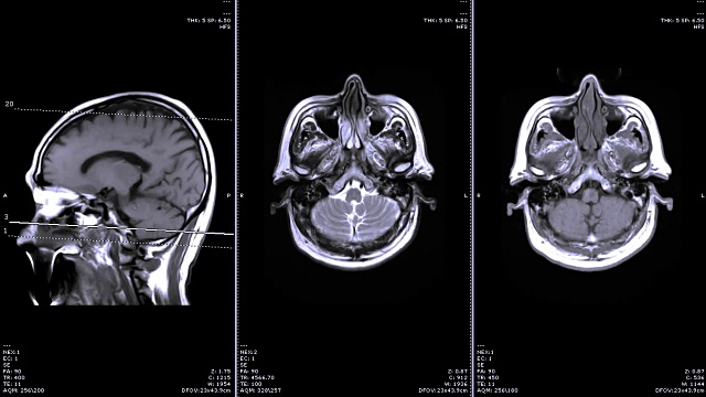 MRI对脑矢状面和冠状面比较。视频下载