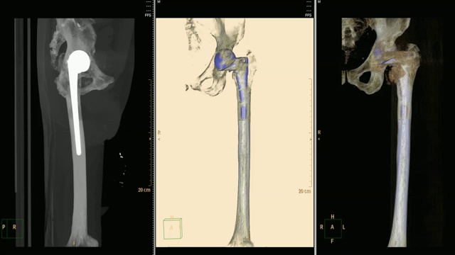 CT扫描骨盆骨图像/髋骨3D渲染图像。视频素材