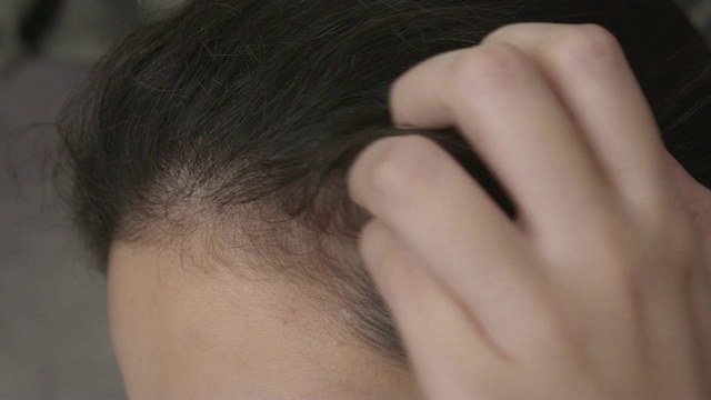 皮肤病，亚洲女人挠头。视频下载
