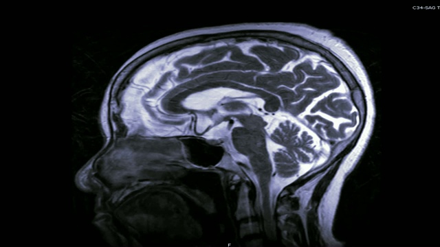 脑矢状面造影剂磁共振成像。脑磁共振成像。视频下载