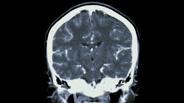 脑CTA或ct冠状面/ 3D渲染图像显示人脑血管。视频下载
