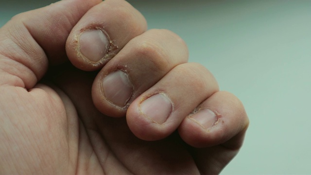 手指甲破损，指甲被咬，角质层干燥视频下载