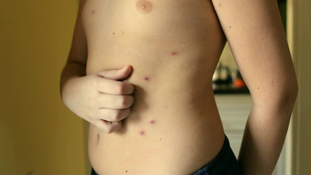 少年与麻疹视频下载