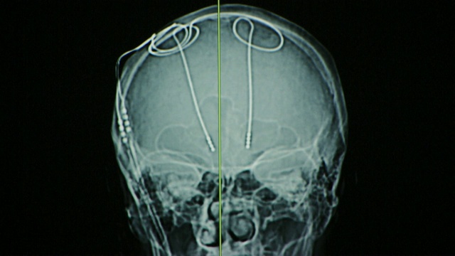 脑深部刺激过程中电极的神经x光图像。视频下载