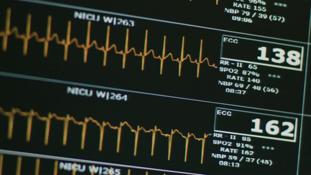 新生儿重症监护室的心电图特写;荷兰角。视频素材