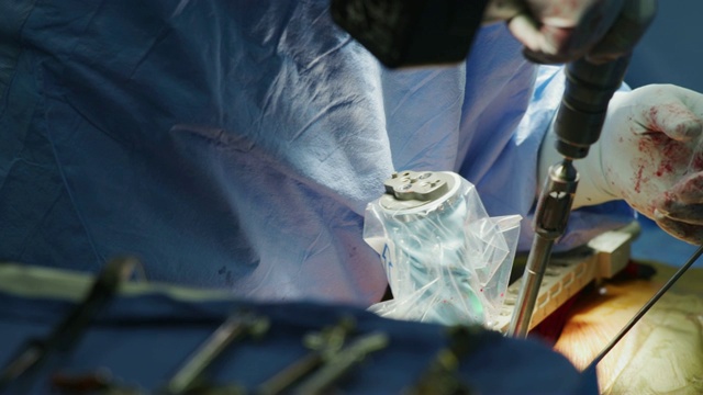 在医疗过程中关闭骨科医生戴手套的手;操作电池驱动的钻头。视频素材