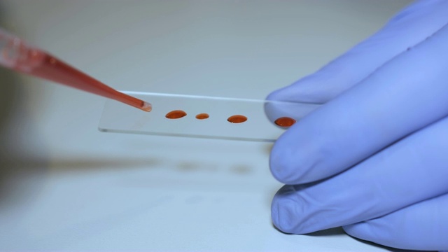 实验室的技术人员拿着移液管检测血液样本在病房进行输血，双手紧闭。医生拿着血液试管的特写。艾滋病/艾滋病毒医院验血。视频素材