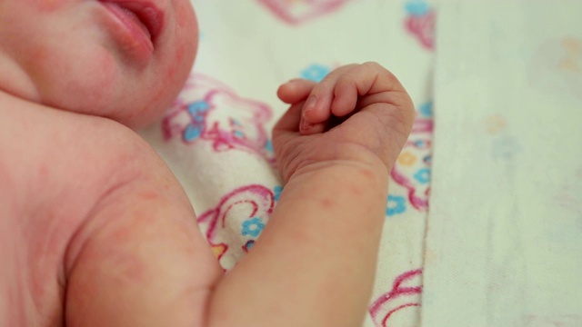 一个皮肤过敏的新生儿躺在医院的床上的特写。视频下载