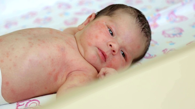 一个皮肤过敏的新生儿躺在医院的床上的特写。视频下载
