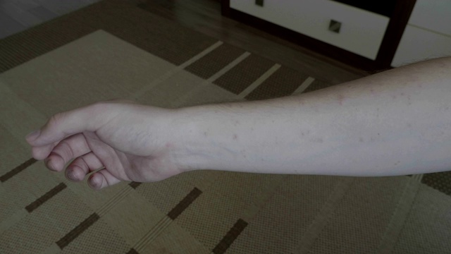 年轻的病人显示他感染了病毒性疾病水痘的手臂在家里视频素材