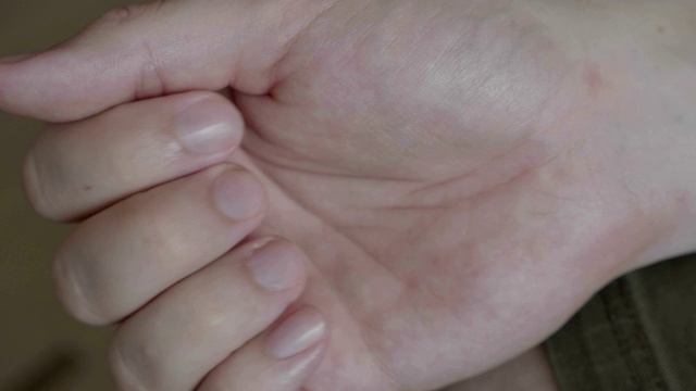 病人的男性手与皮疹或荨麻疹皮肤症状的特写视频素材