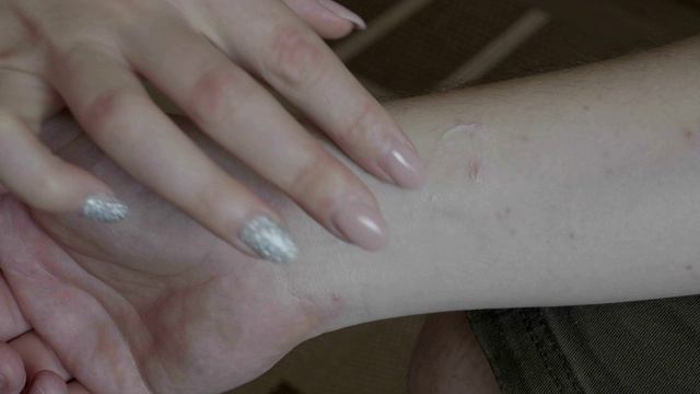 年轻女性用手涂抹抗过敏治疗霜在有皮炎或皮疹过敏的男性手臂上视频素材