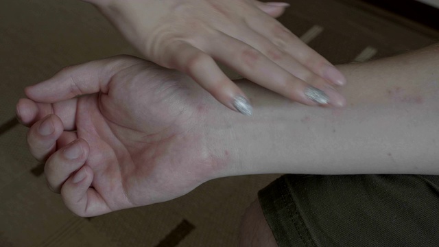年轻女性用润肤膏治疗年轻男性患者手有表皮性湿疹或天花视频下载