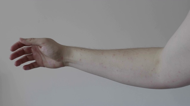 对年轻人过敏性男性手臂皮肤严重疹的皮肤病概念视频素材