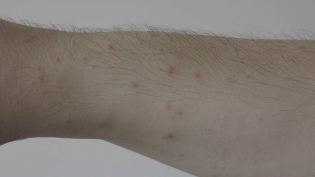 由过敏或病毒性疾病引起的水痘或湿疹的年轻男子手臂上的红斑特写视频下载