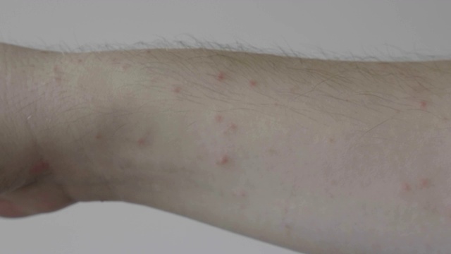手有红疹的年轻人有皮肤问题皮肤病和医疗问题的概念视频素材