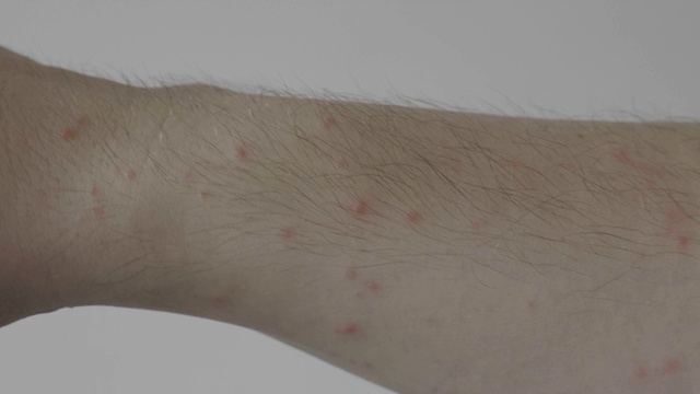 青少年皮肤敏感瘙痒，手臂有红疹、湿疹或过敏症状视频素材