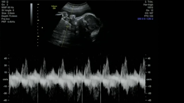 不可思议的婴儿心率声-超声扫描妊娠3d和4d超声检查妊娠胎儿人类胚胎检查胎儿超声检查26周中期妊娠女婴视频下载