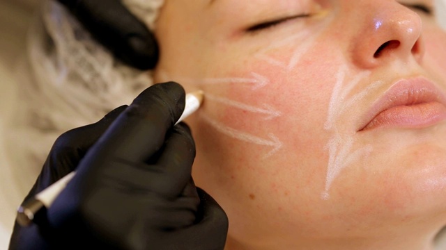 美容师用一支白色铅笔在病人的脸上画出轮廓。视频下载