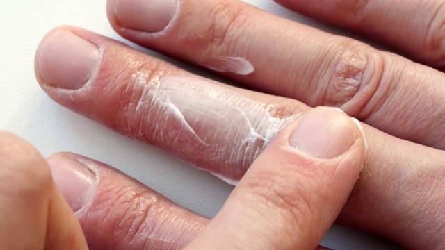 男人用面霜治疗手臂干裂的皮肤。皮肤病学概念。视频下载