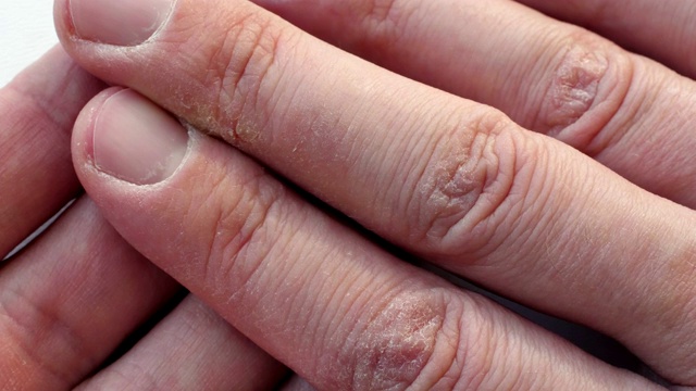 手指干燥皲裂。有皮肤问题的手。视频素材